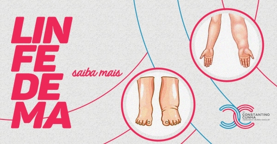 Saiba mais sobre o Linfedema