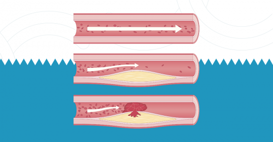 Arteriosclerose: o que é, causa e tratamentos