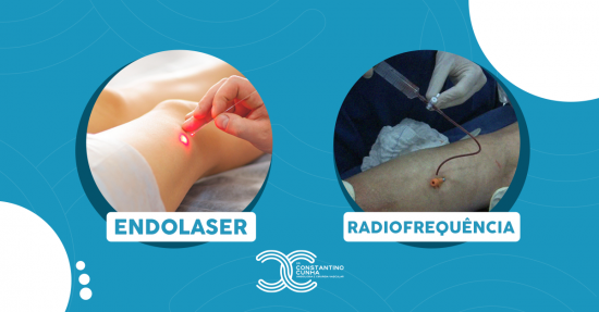 Tratamento de Varizes: Cirurgia com Endolaser x Radiofrequência